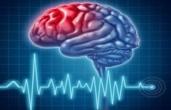 Cerebral Vascular Accident(Stroke)